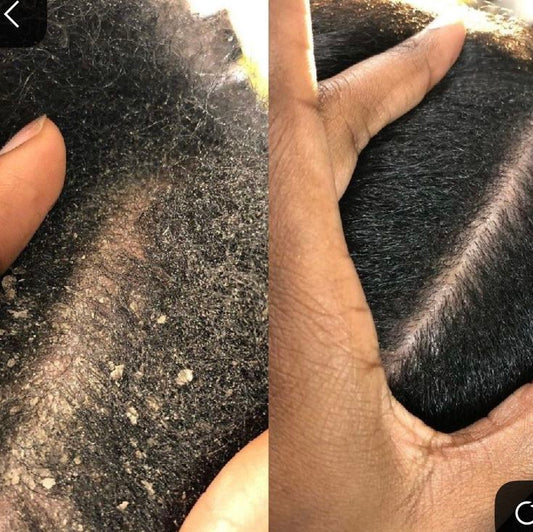 Dry, Flaky, or Itchy? What Your Scalp Is Trying to Tell You